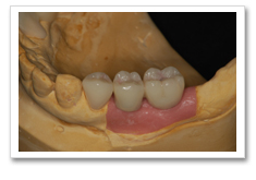 インプラント治療の流れ-人工の歯を取り付け