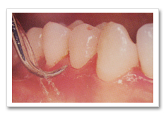 成人予防プログラムの内容-歯石の除去について