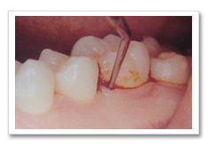 成人予防プログラムの内容-歯石の除去について 2